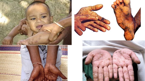 Nhiễm độc Chì (Pb) – Mối nguy cho hệ thần kinh và trí não